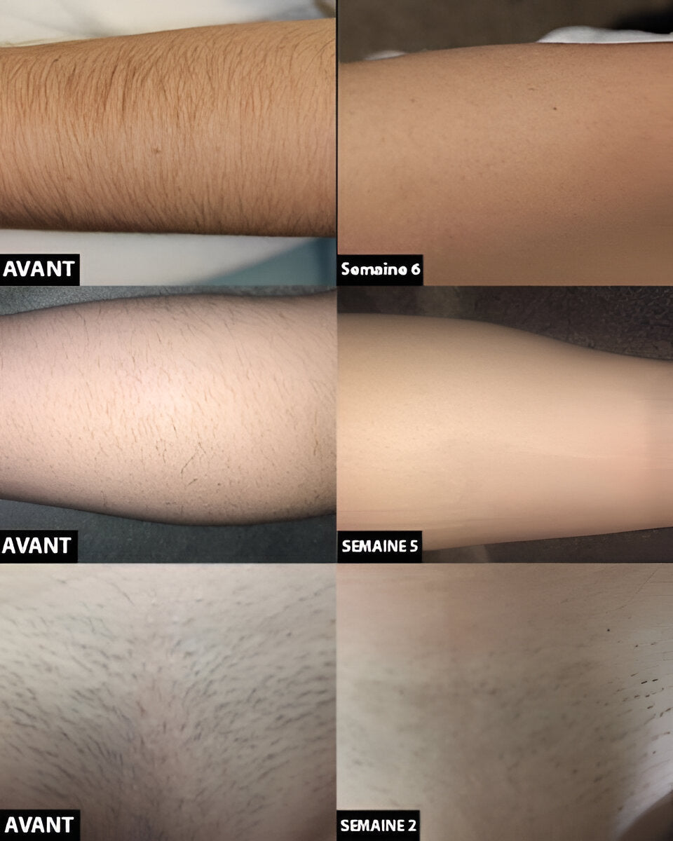 Permanent laser hair removal
