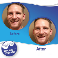 Smile Veneer (Upper & Lower Included)