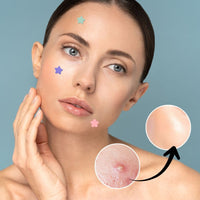 Hydrocolloid Pimple Acne Patch Sticker