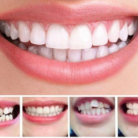 Invisible Dental Realignment Tray