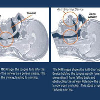 Apnea Tongue Stabilizing Device