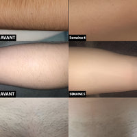 Permanent laser hair removal